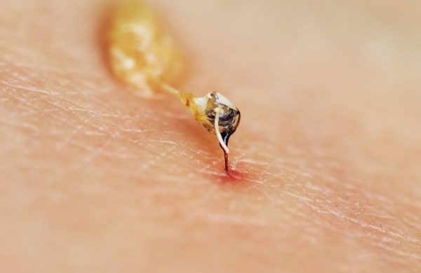 Insektenstiche nicht unterschätzen dringend den Hausarzt anrufen im Notfall